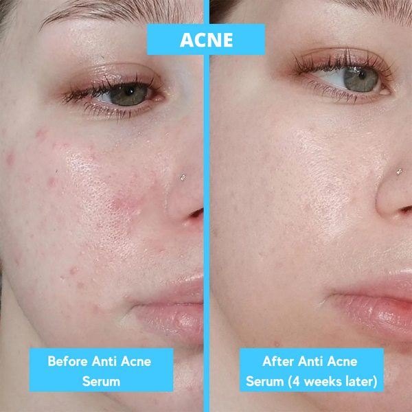 Anti Acne Serum